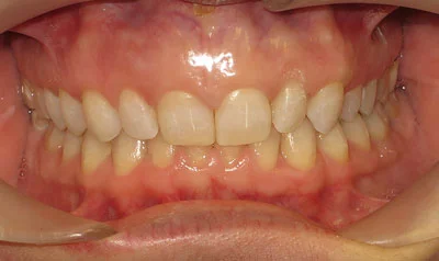 Invisalign Cases case 107 — after