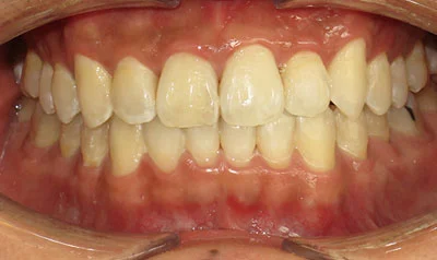 Invisalign Cases case 108 — before