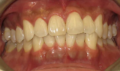 Invisalign Cases case 108 — after