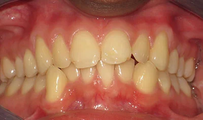 Invisalign Cases case 109 — before