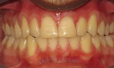 Invisalign Cases case 109 — after