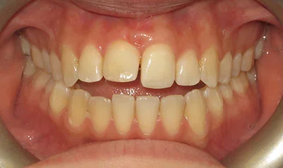 Invisalign Cases case 110 — before