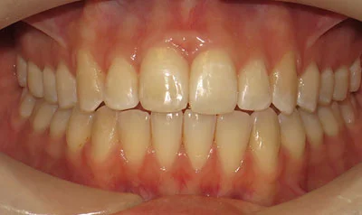 Invisalign Cases case 110 — after