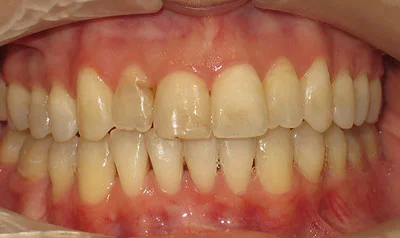 Invisalign Cases case 111 — before