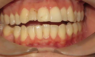 Invisalign Cases case 111 — after