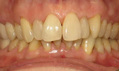 Invisalign Cases case 112 — before