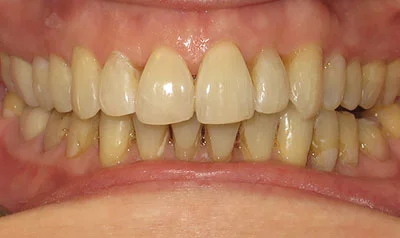 Invisalign Cases case 112 — after