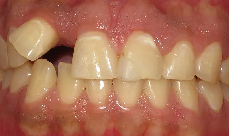 Invisalign Cases case 137 — before
