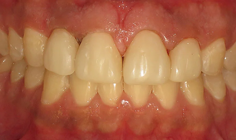 Invisalign Cases case 137 — after