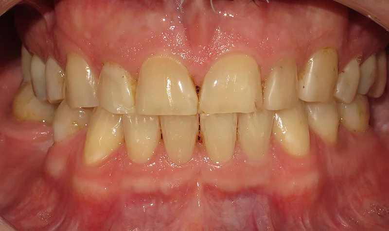 Invisalign Cases case 140 — before
