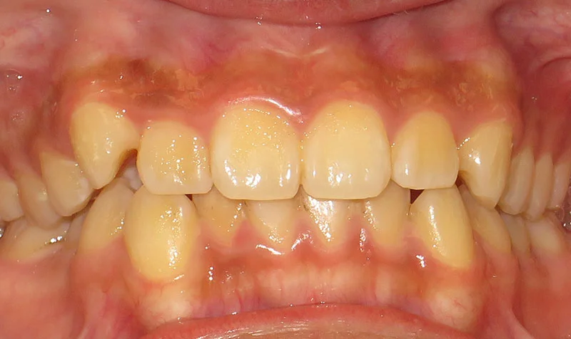 Invisalign Cases case 148 — before