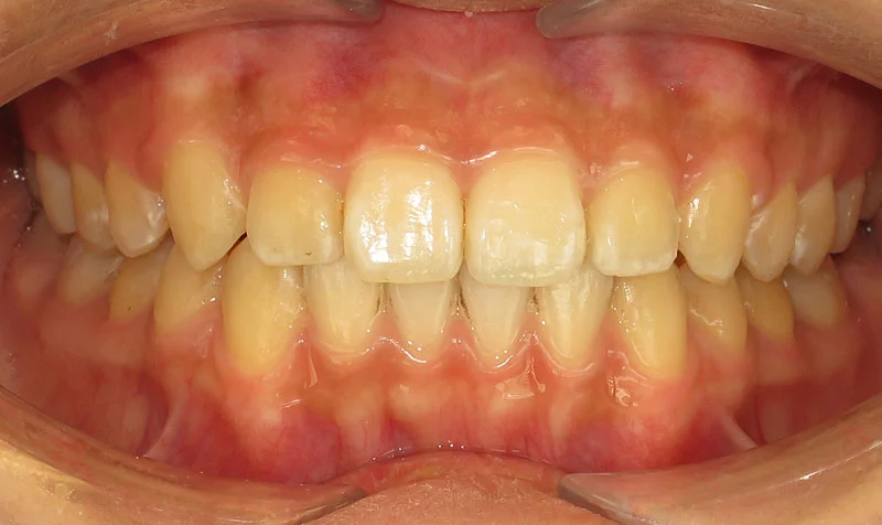 Invisalign Cases case 148 — after