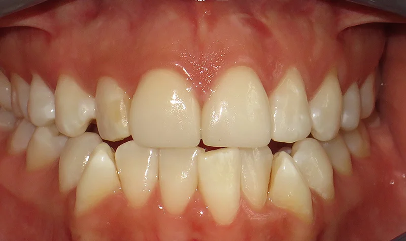 Invisalign Cases case 150 — before