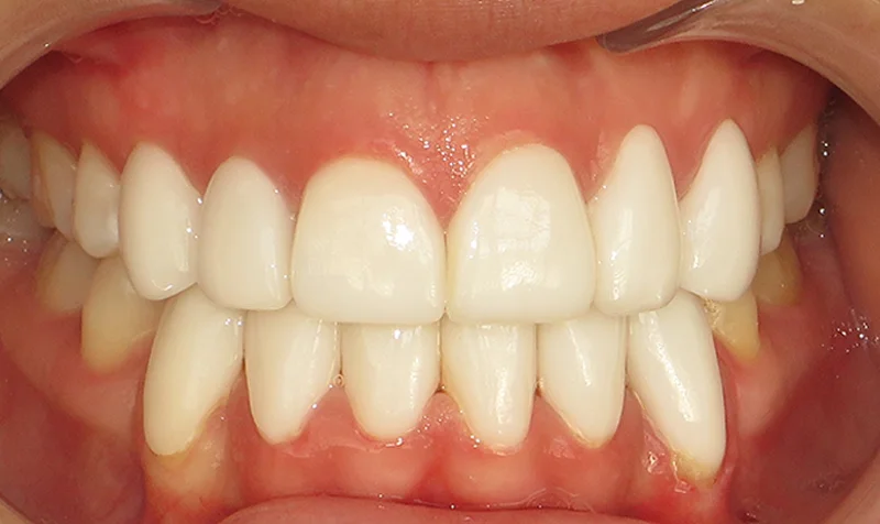 Invisalign Cases case 150 — after