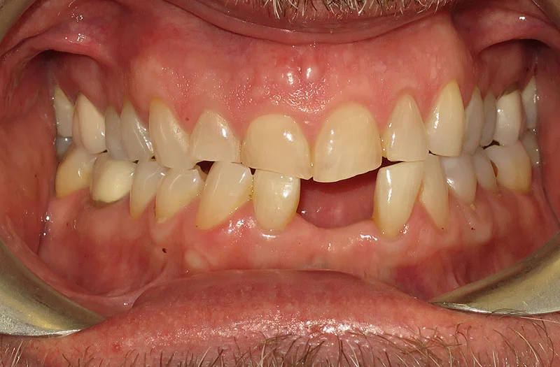 Invisalign Cases case 177 — before