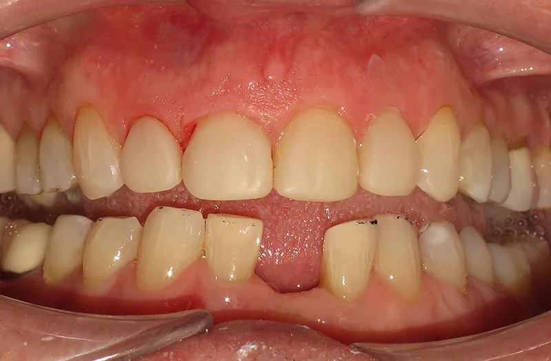 Invisalign Cases case 177 — after