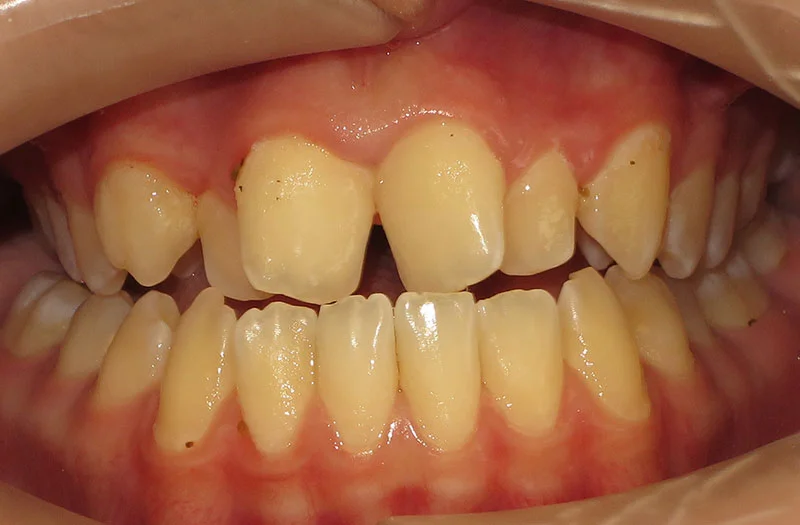 Invisalign Cases case 179 — before