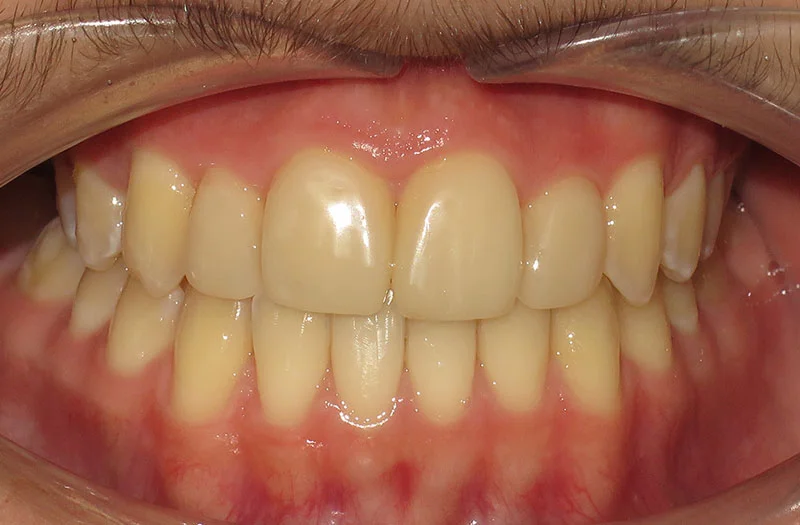 Invisalign Cases case 179 — after