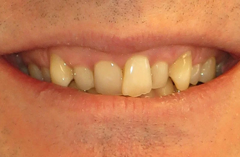 Invisalign Cases case 183 — before