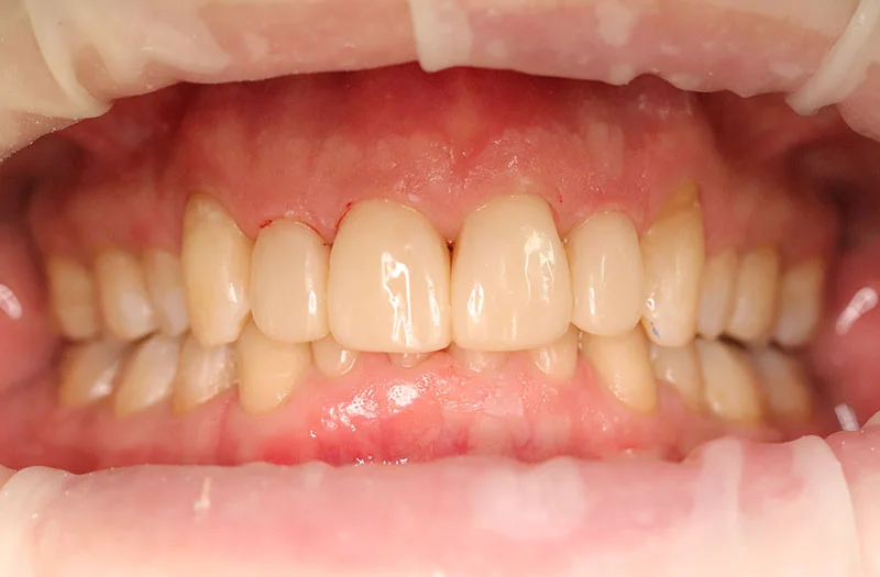 Invisalign Cases case 183 — after