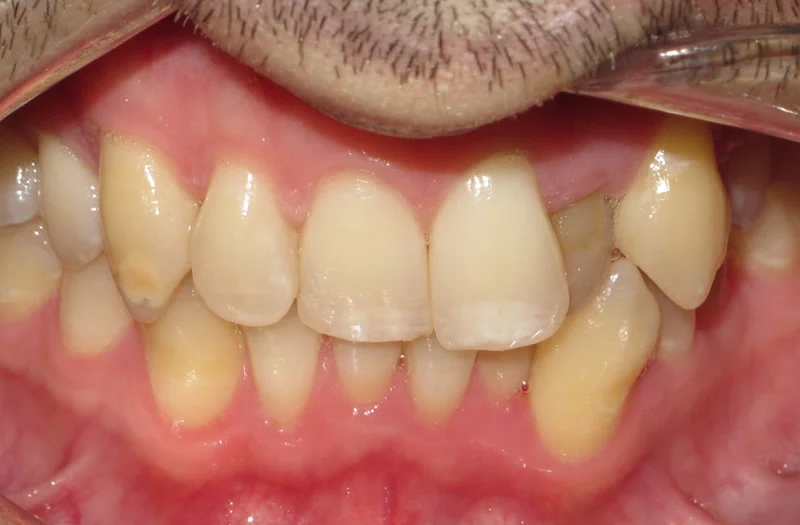 Invisalign Cases case 187 — before