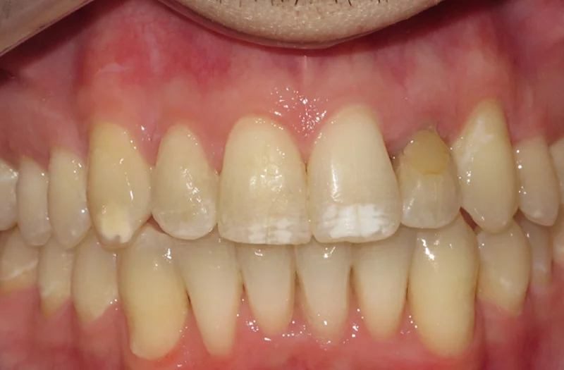 Invisalign Cases case 187 — after