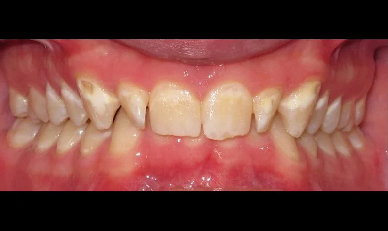 Invisalign Cases case 201 — before