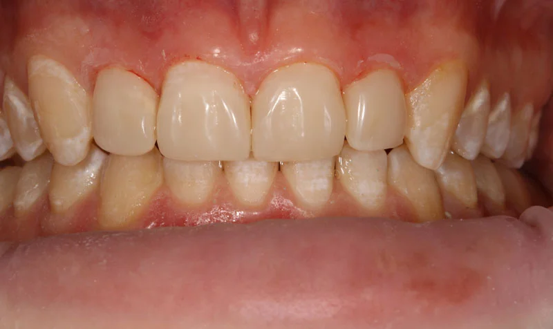 Invisalign Cases case 201 — after
