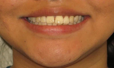Invisalign Cases case 33 — before