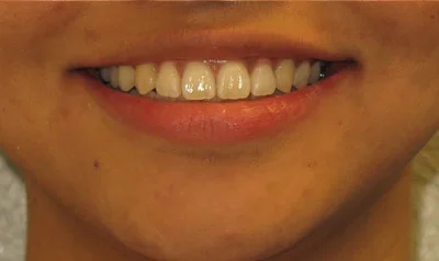 Invisalign Cases case 33 — after