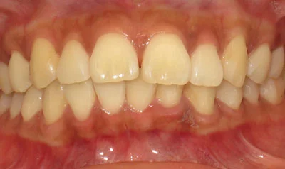 Invisalign Cases case 34 — before