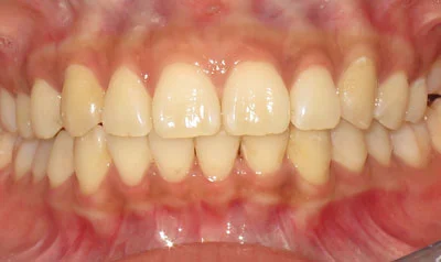 Invisalign Cases case 34 — after