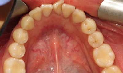 Invisalign Cases case 35 — before