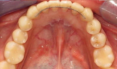 Invisalign Cases case 35 — after