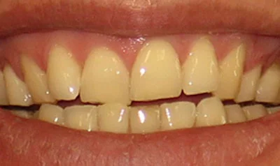 Invisalign Cases case 77 — before