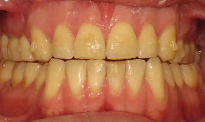 Invisalign Cases case 77 — after