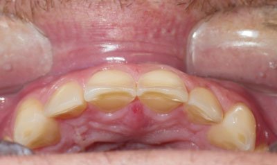 Porcelain Crown Cases case 7 — before