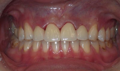 Porcelain Crown Cases
