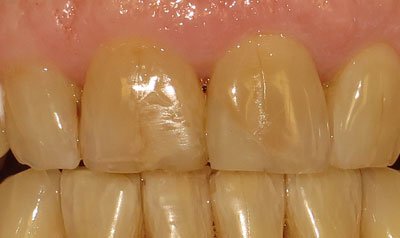 Porcelain Crown Cases case 8 — before