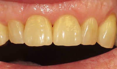Porcelain Crown Cases case 8 — after