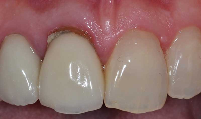 Porcelain Crown Cases case 120 — before