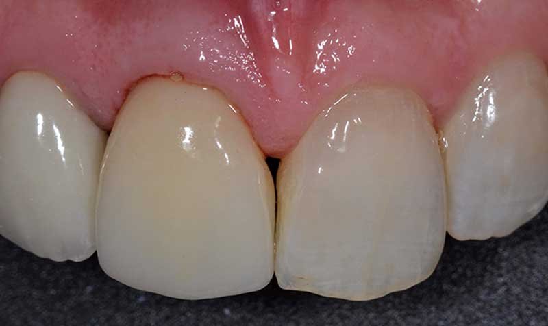 Porcelain Crown Cases case 120 — after