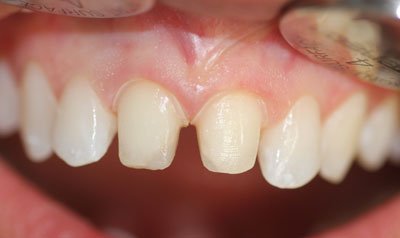 Porcelain Crown Cases case 51 — before
