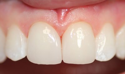 Porcelain Crown Cases case 51 — after