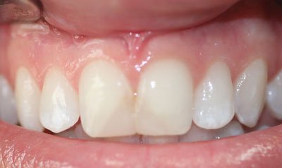 Porcelain Crown Cases case 55 — before