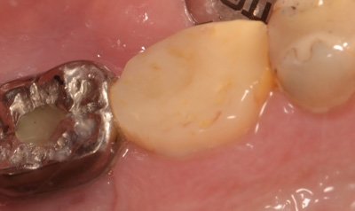 Porcelain Crown Cases case 63 — before