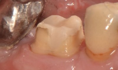 Porcelain Crown Cases case 63 — after