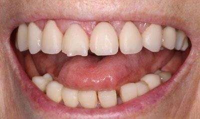 Porcelain Crown Cases case 81 — before