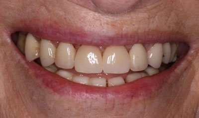 Porcelain Crown Cases case 81 — after