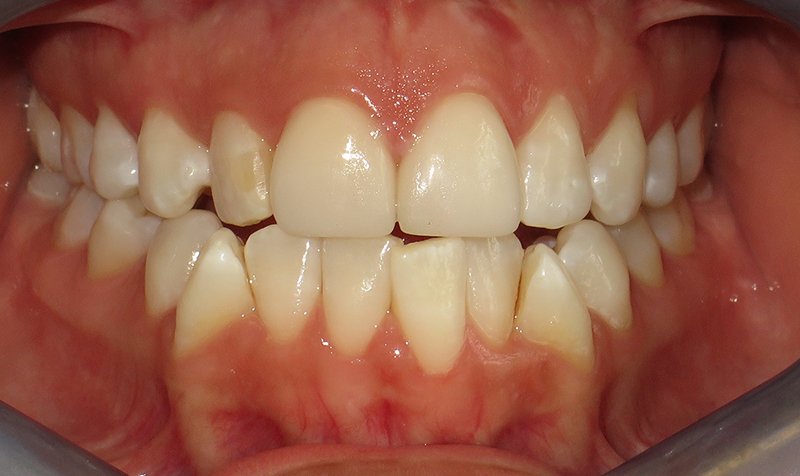 Porcelain Veneer Cases case 165 — before
